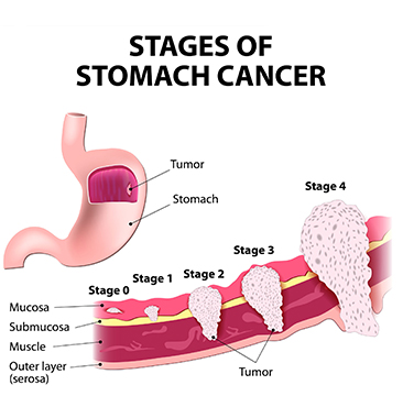 Gastric Cancer